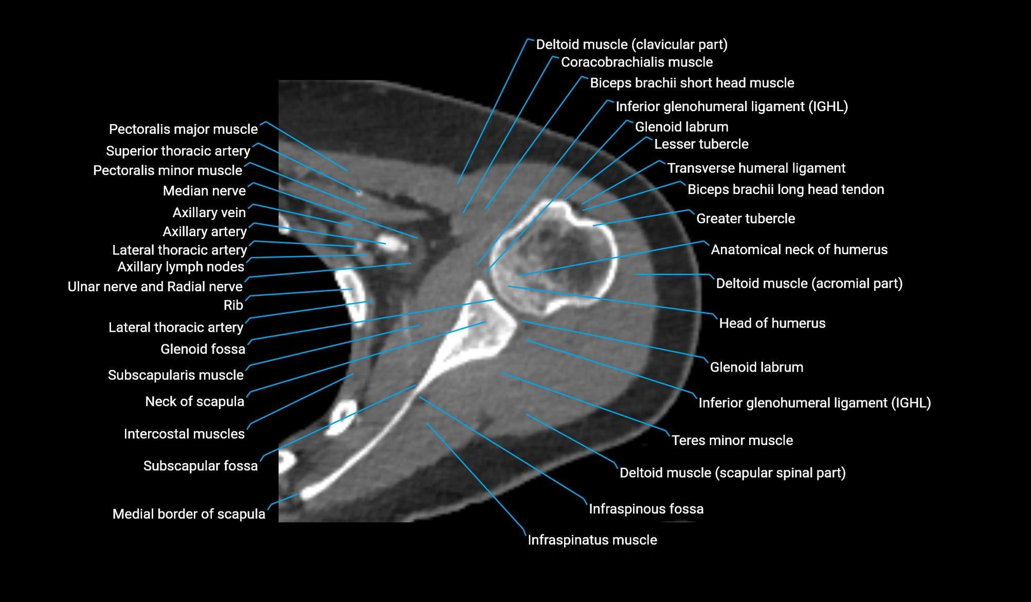CT upper arm axial  cross sectional anatomy labelled radiology image -00104.webp